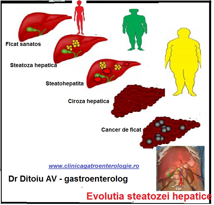dieta alimentara pentru steatoza hepatica