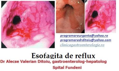 Esofagita de reflux