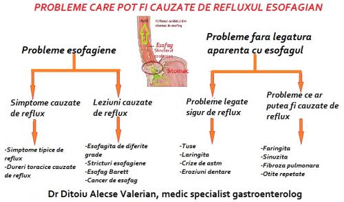 Refluxul esofagian simptome