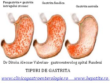 tipuri-de-gastrita