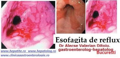 Esofagita de reflux