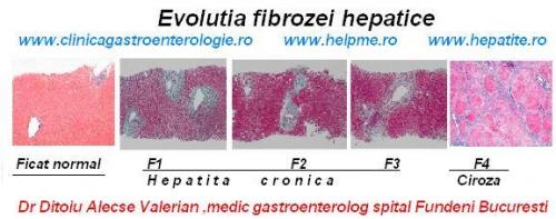 Evolutia fibrozei hepatice