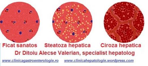 Evolutia steatozei