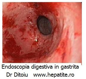 Gastrita dg