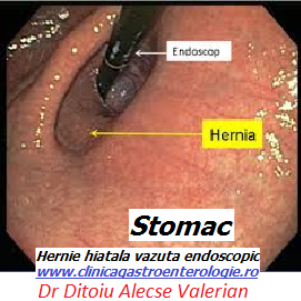 Hernie endoscopic