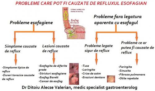 Refluxul esofagian simptome