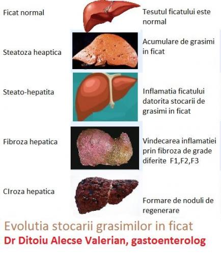 steatoza evolutie 2 (1)